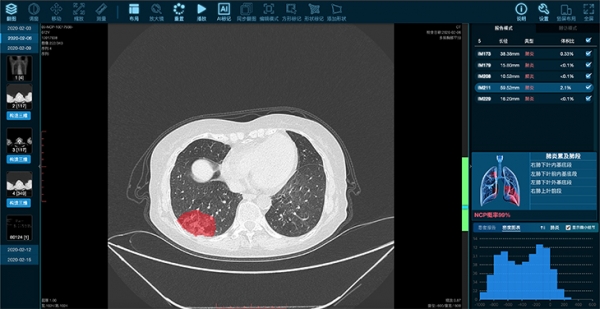 AI“上岗”，缓解新冠肺炎CT阅片压力