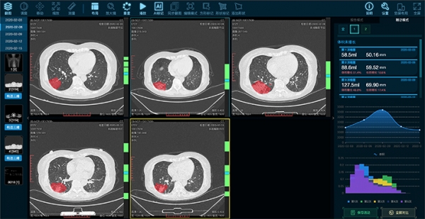 AI“上岗”，缓解新冠肺炎CT阅片压力